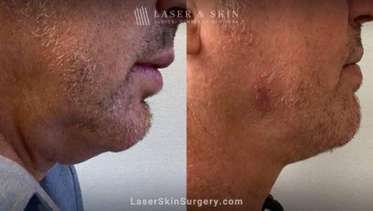 Dr. Lloyd Hoffman laser treatment result — New York, NY