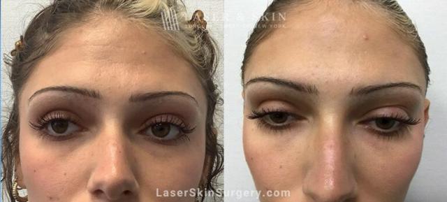 Laser Skin Resurfacing result at Dr. Lloyd Hoffman in New York, NY