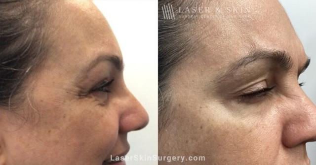 Laser Skin Resurfacing result at Dr. Lloyd Hoffman in New York, NY