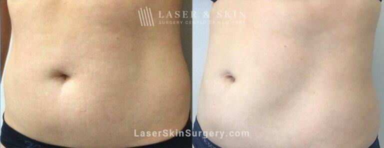 Dr. Lloyd Hoffman coolsculpting result — New York, NY