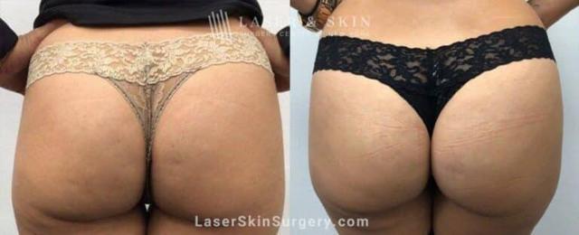Brazilian Butt Lift result at Dr. Lloyd Hoffman in New York, NY
