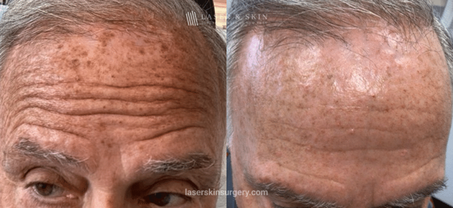 Laser Skin Resurfacing result at Dr. Lloyd Hoffman in New York, NY