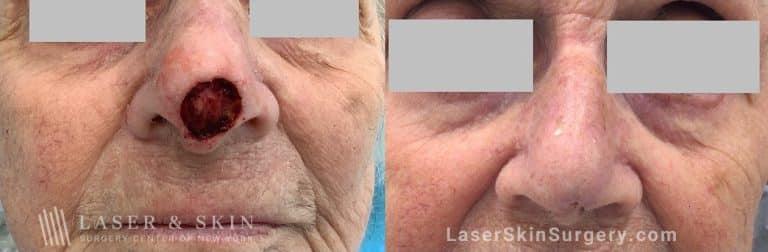 Dr. Lloyd Hoffman laser treatment result — New York, NY