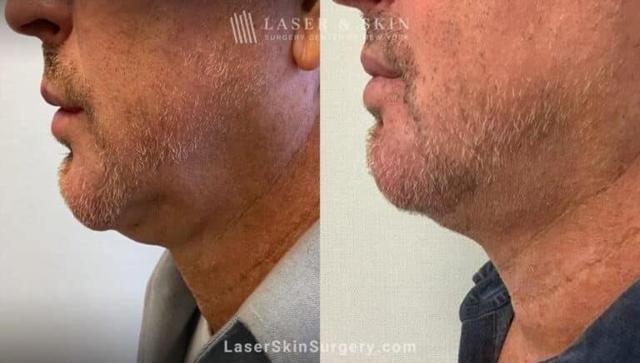 Laser Skin Resurfacing result at Dr. Lloyd Hoffman in New York, NY