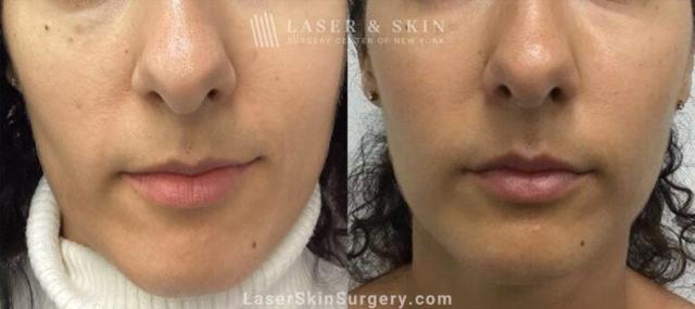 Laser Skin Resurfacing result at Dr. Lloyd Hoffman in New York, NY