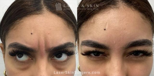 Laser Skin Resurfacing result at Dr. Lloyd Hoffman in New York, NY