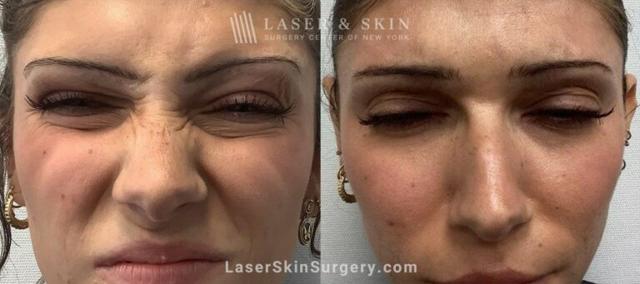 Laser Skin Resurfacing result at Dr. Lloyd Hoffman in New York, NY