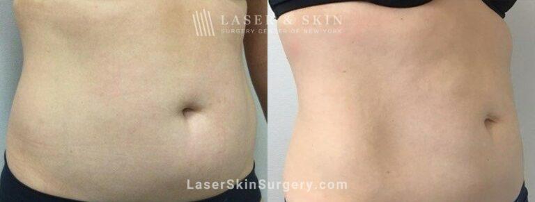 Dr. Lloyd Hoffman coolsculpting result — New York, NY