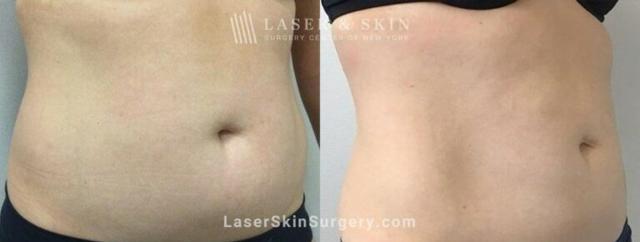 Thigh Lift result at Dr. Lloyd Hoffman in New York, NY