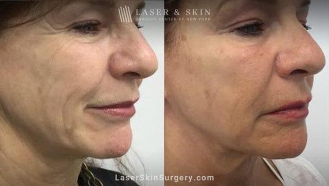 Morpheus8 result at Dr. Lloyd Hoffman in New York, NY