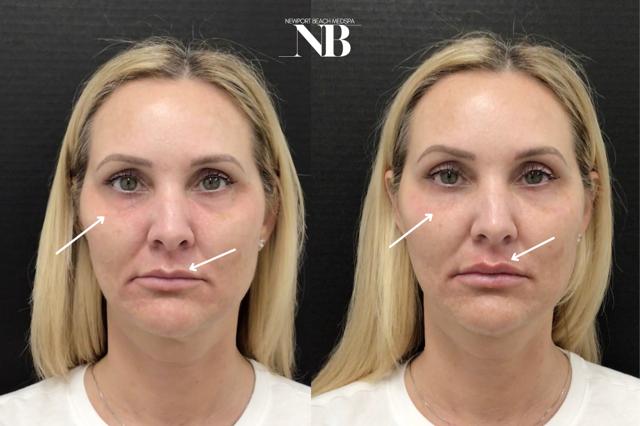 Dermal Fillers result at Newport Beach MedSpa in Newport Beach, CA