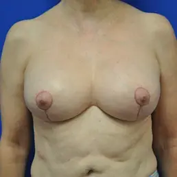 Dr. Simona V. Pautler, MD FACS: Plastic Surgery Pittsburgh breast lift after — McMurray, PA