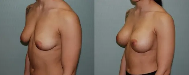 Breast Augmentation result at Finesse Cosmetic Surgery in Waltham, MA