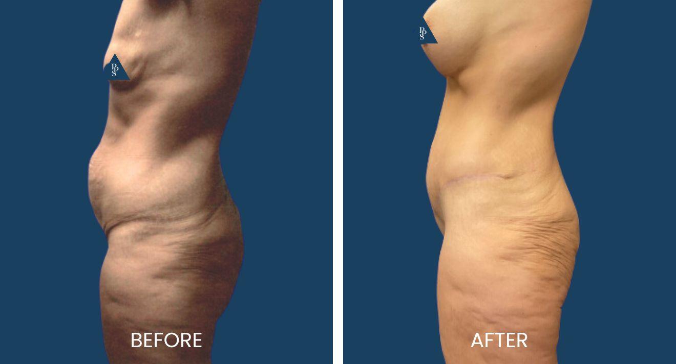Plano Plastic Surgery — MedSpa result — Plano, TX