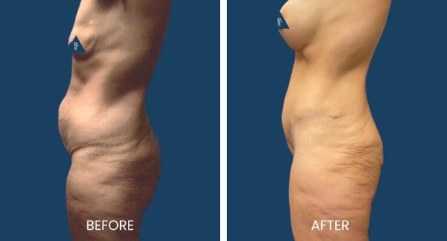 Tummy Tuck result at Plano Plastic Surgery — MedSpa in Plano, TX