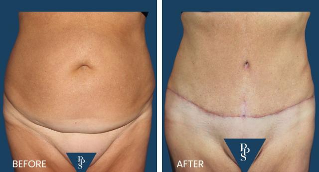 Mommy Makeover result at Plano Plastic Surgery — MedSpa in Plano, TX