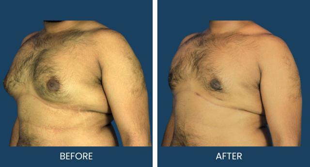 Gynecomastia Surgery result at Plano Plastic Surgery — MedSpa in Plano, TX