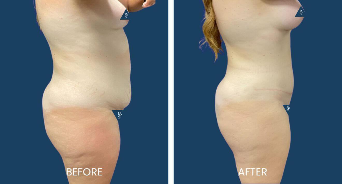 Plano Plastic Surgery — MedSpa result — Plano, TX