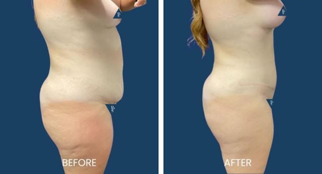 Tummy Tuck result at Plano Plastic Surgery — MedSpa in Plano, TX