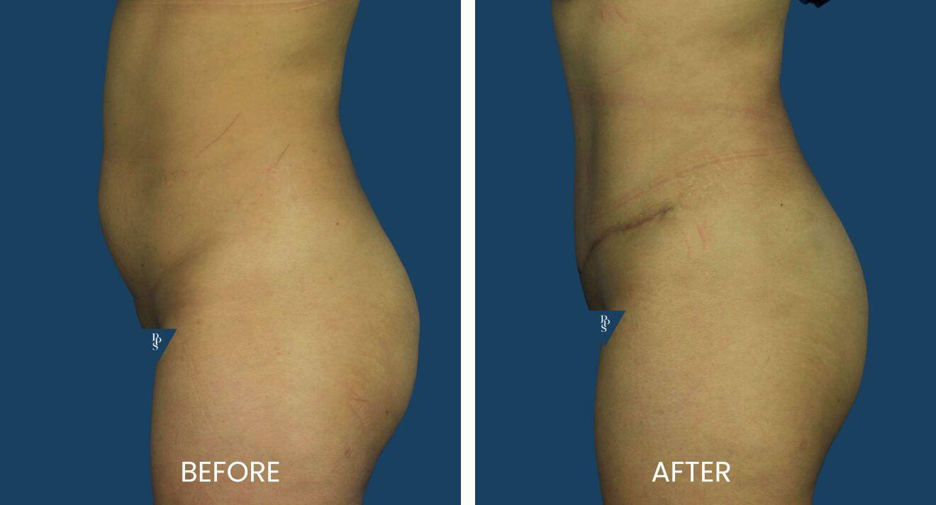 Plano Plastic Surgery — MedSpa result — Plano, TX