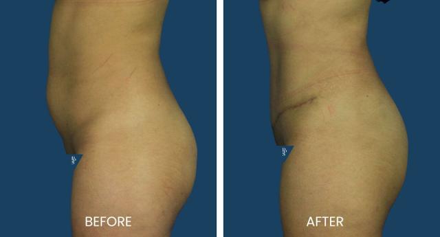 Tummy Tuck result at Plano Plastic Surgery — MedSpa in Plano, TX
