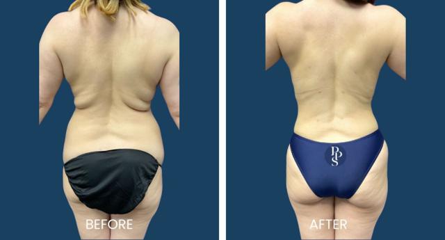 Liposuction result at Plano Plastic Surgery — MedSpa in Plano, TX