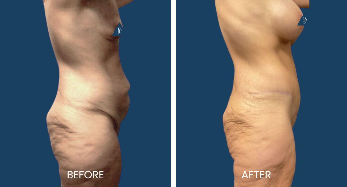 Plano Plastic Surgery — MedSpa result — Plano, TX