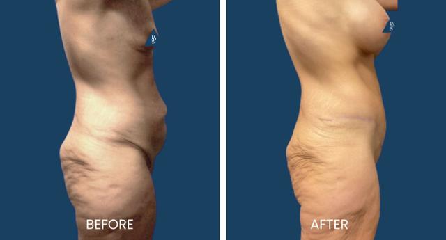 Tummy Tuck result at Plano Plastic Surgery — MedSpa in Plano, TX