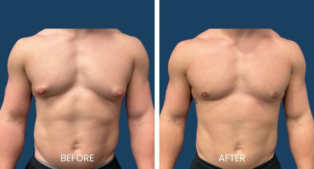 Gynecomastia Surgery result at Plano Plastic Surgery — MedSpa in Plano, TX