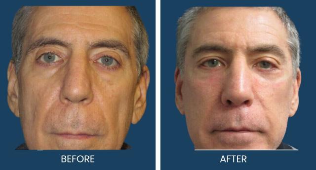 Deep Plane Facelift result at Plano Plastic Surgery — MedSpa in Plano, TX