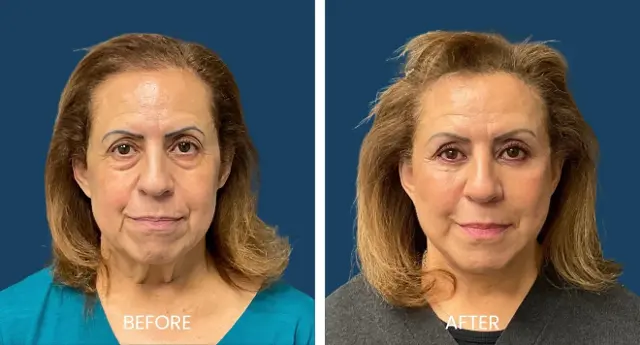 Blepharoplasty result at Plano Plastic Surgery — MedSpa in Plano, TX