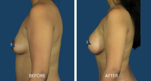Breast Augmentation result at Plano Plastic Surgery — MedSpa in Plano, TX