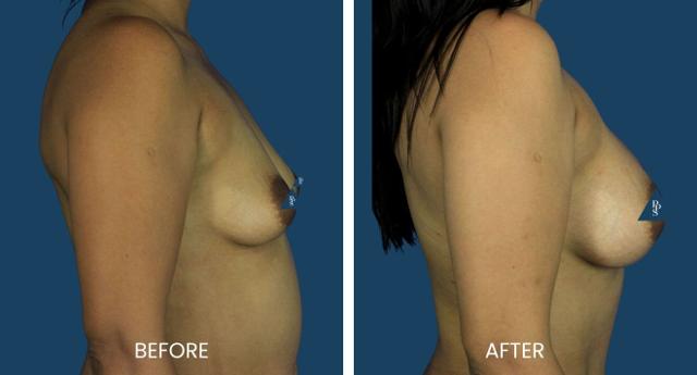 Breast Augmentation result at Plano Plastic Surgery — MedSpa in Plano, TX