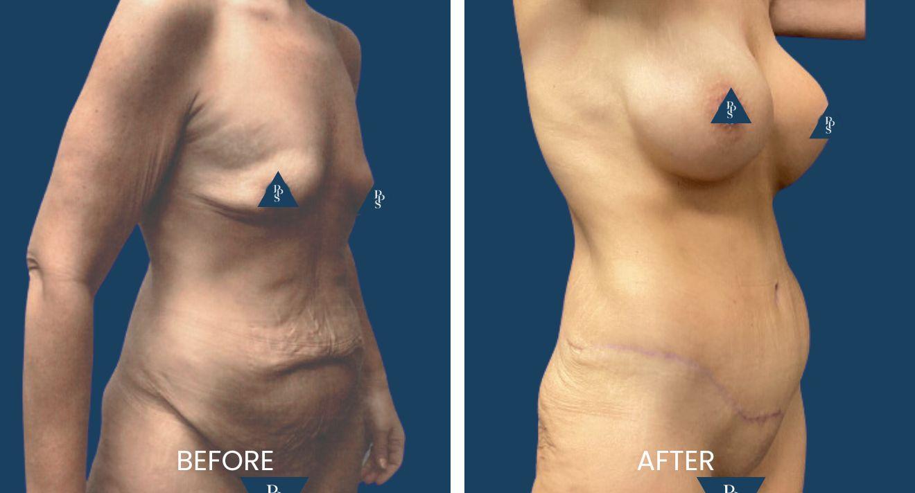 Plano Plastic Surgery — MedSpa result — Plano, TX