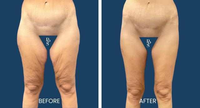 Thigh Lift result at Plano Plastic Surgery — MedSpa in Plano, TX