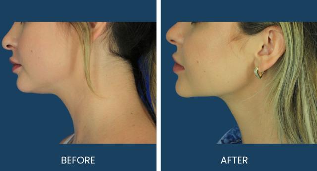Deep Plane Facelift result at Plano Plastic Surgery — MedSpa in Plano, TX