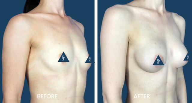 Breast Augmentation result at Plano Plastic Surgery — MedSpa in Plano, TX