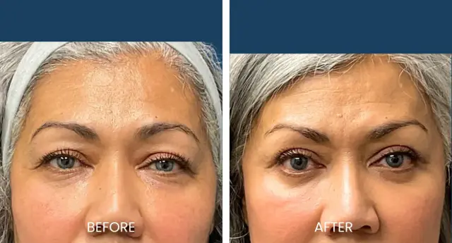 Blepharoplasty result at Plano Plastic Surgery — MedSpa in Plano, TX