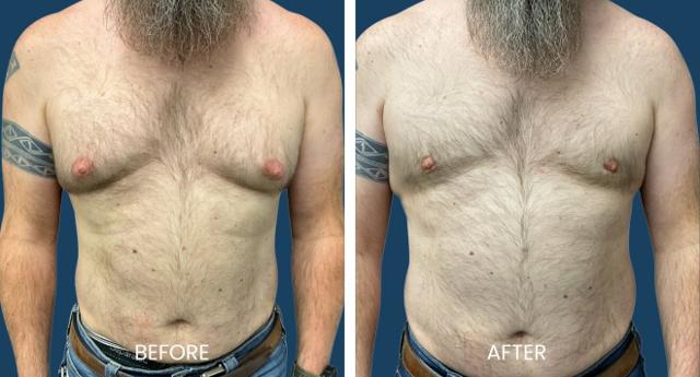 Gynecomastia Surgery result at Plano Plastic Surgery — MedSpa in Plano, TX