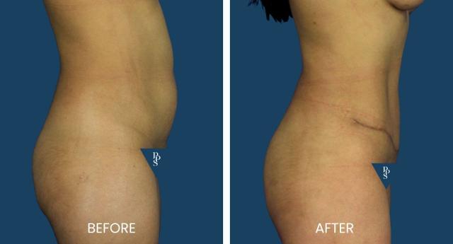 Tummy Tuck result at Plano Plastic Surgery — MedSpa in Plano, TX