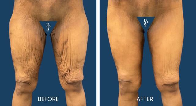 Thigh Lift result at Plano Plastic Surgery — MedSpa in Plano, TX