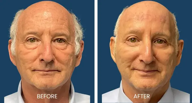 Blepharoplasty result at Plano Plastic Surgery — MedSpa in Plano, TX