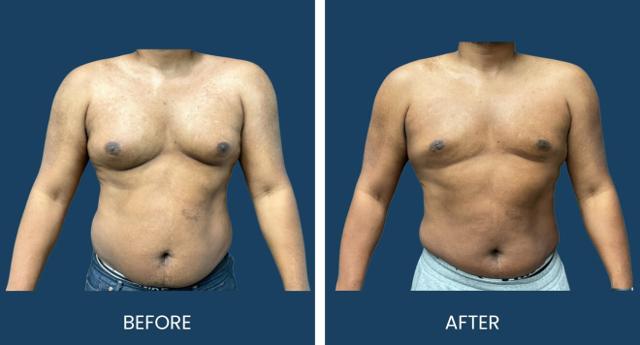 Gynecomastia Surgery result at Plano Plastic Surgery — MedSpa in Plano, TX