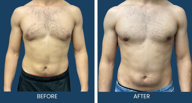 Gynecomastia Surgery result at Plano Plastic Surgery — MedSpa in Plano, TX