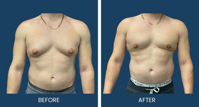Gynecomastia Surgery result at Plano Plastic Surgery — MedSpa in Plano, TX