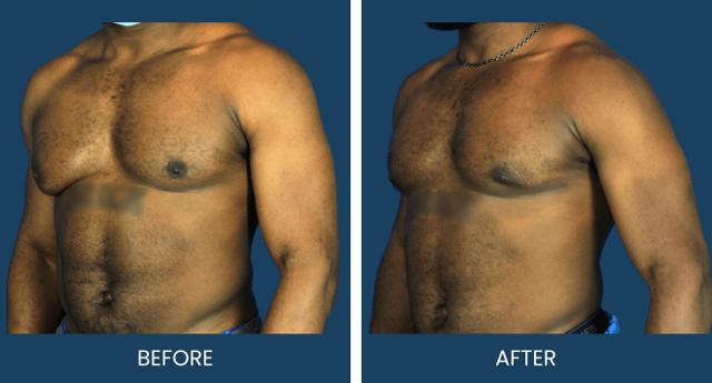 Gynecomastia Surgery result at Plano Plastic Surgery — MedSpa in Plano, TX