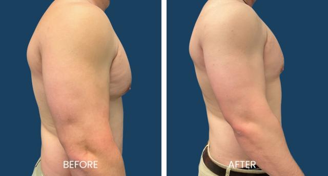Gynecomastia Surgery result at Plano Plastic Surgery — MedSpa in Plano, TX