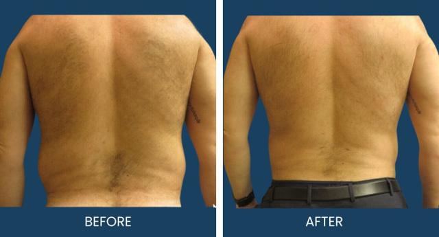 Liposuction result at Plano Plastic Surgery — MedSpa in Plano, TX