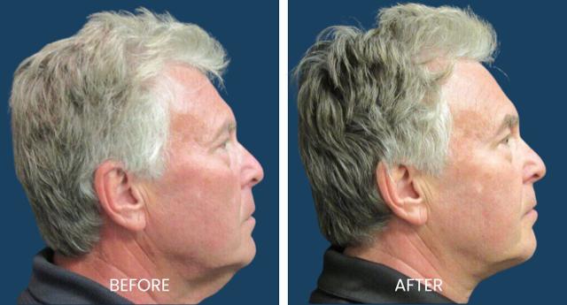 Deep Plane Facelift result at Plano Plastic Surgery — MedSpa in Plano, TX