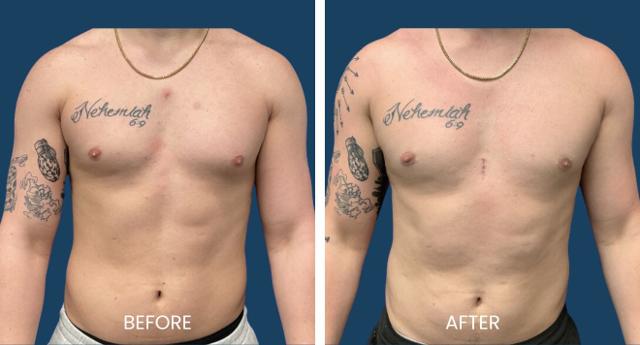 Gynecomastia Surgery result at Plano Plastic Surgery — MedSpa in Plano, TX